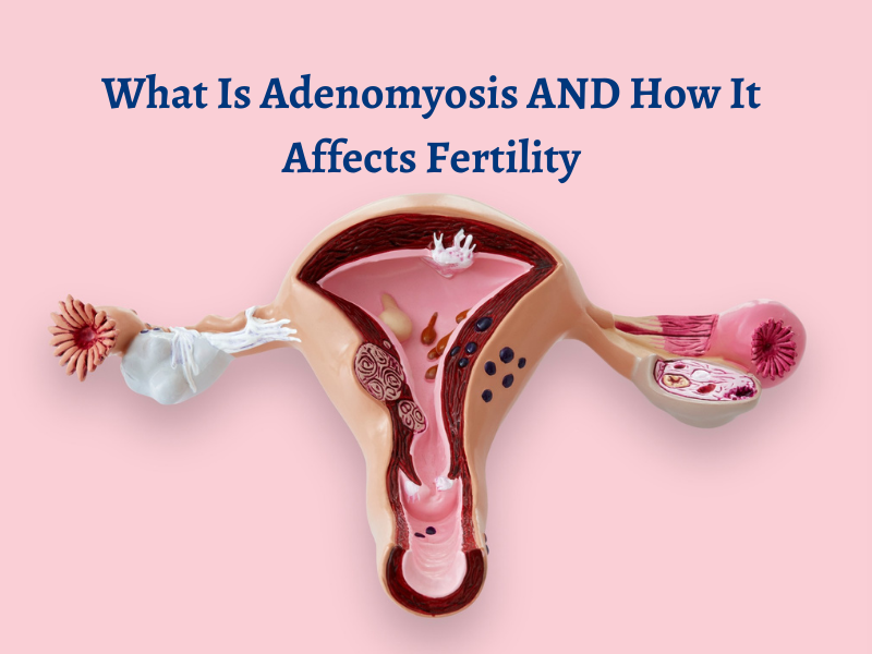 Adenomyosis and infertility